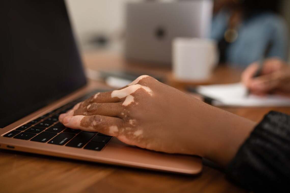 Image of a hand typing at a laptop. The person pictured is Black and has Vitiligo. They are taking notes with a pen with their other hand. Image via Nappy.co